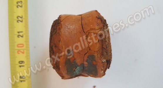 Calculs biliaires de bovins