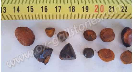 Calculs biliaires de bovins