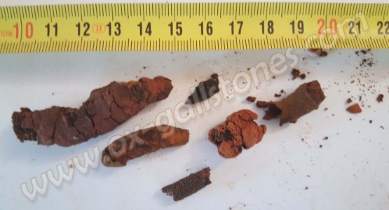 Calculs biliaires de bovins